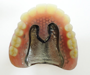 金属床(コバルトクロム)義歯